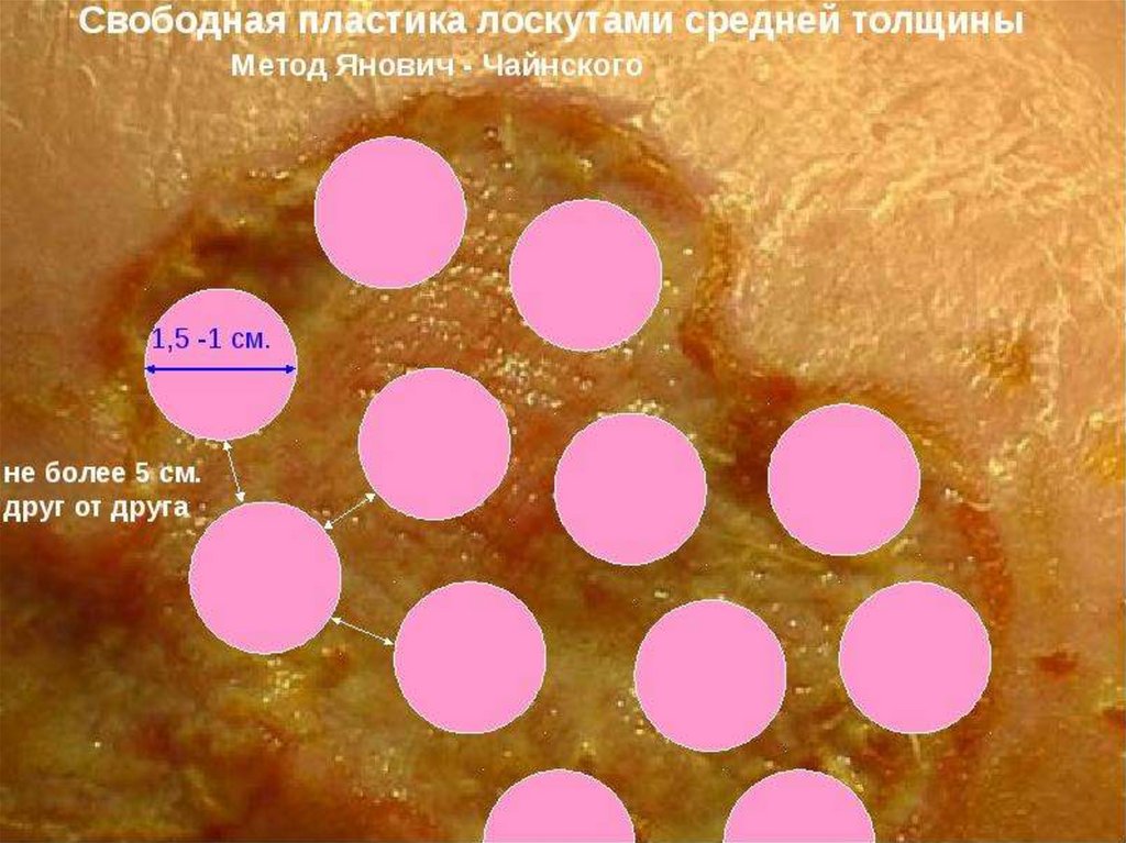 Свободный лоскут. Метод Янович Чайнского. Кожная пластика сетчатым лоскутом. Свободная трансплантация кожного лоскута.