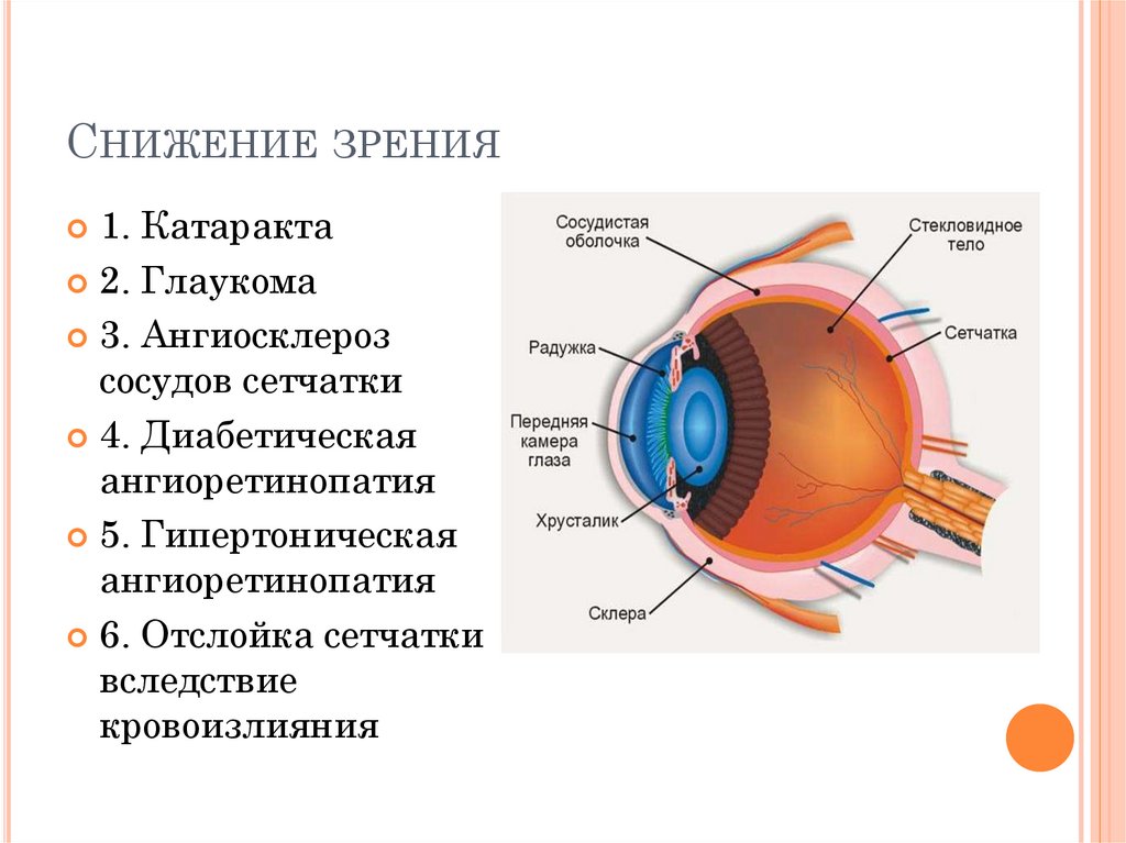 Катаракта схема