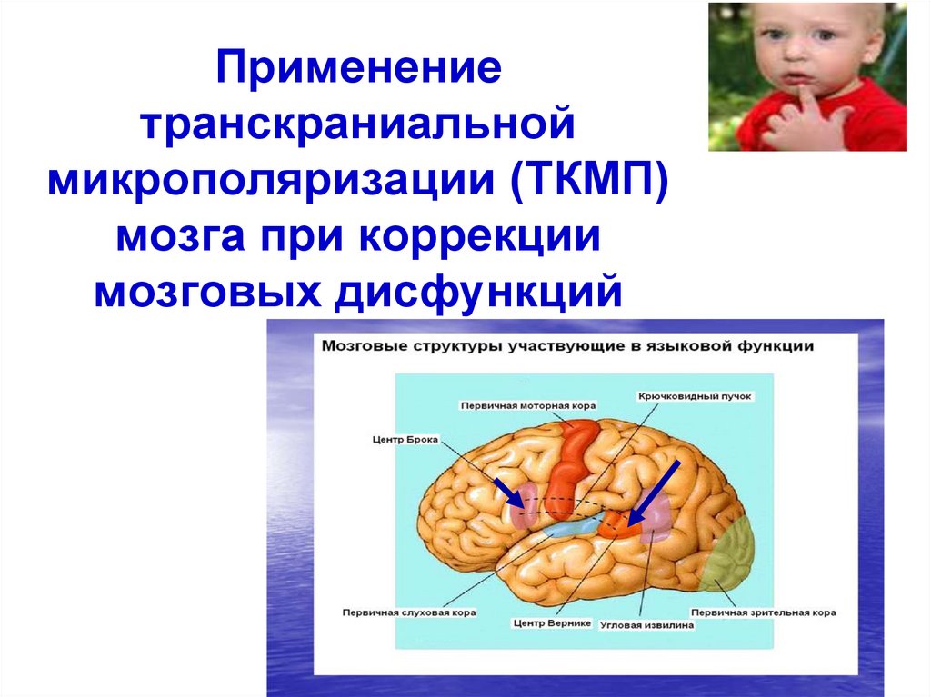 Легкая дисфункция мозга. ТКМП головного мозга у детей. Функциональные нарушения головного мозга. Микрополяризация мозга. Транскраниальной микрополяризации.
