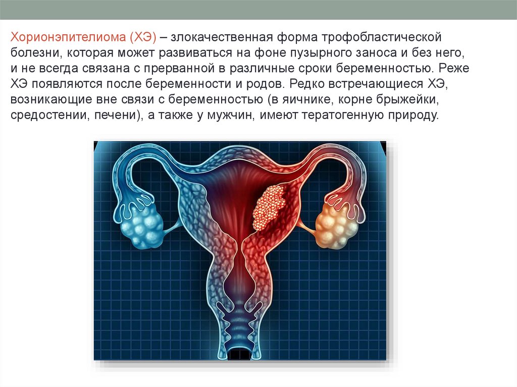 Хорионэпителиома - презентация онлайн