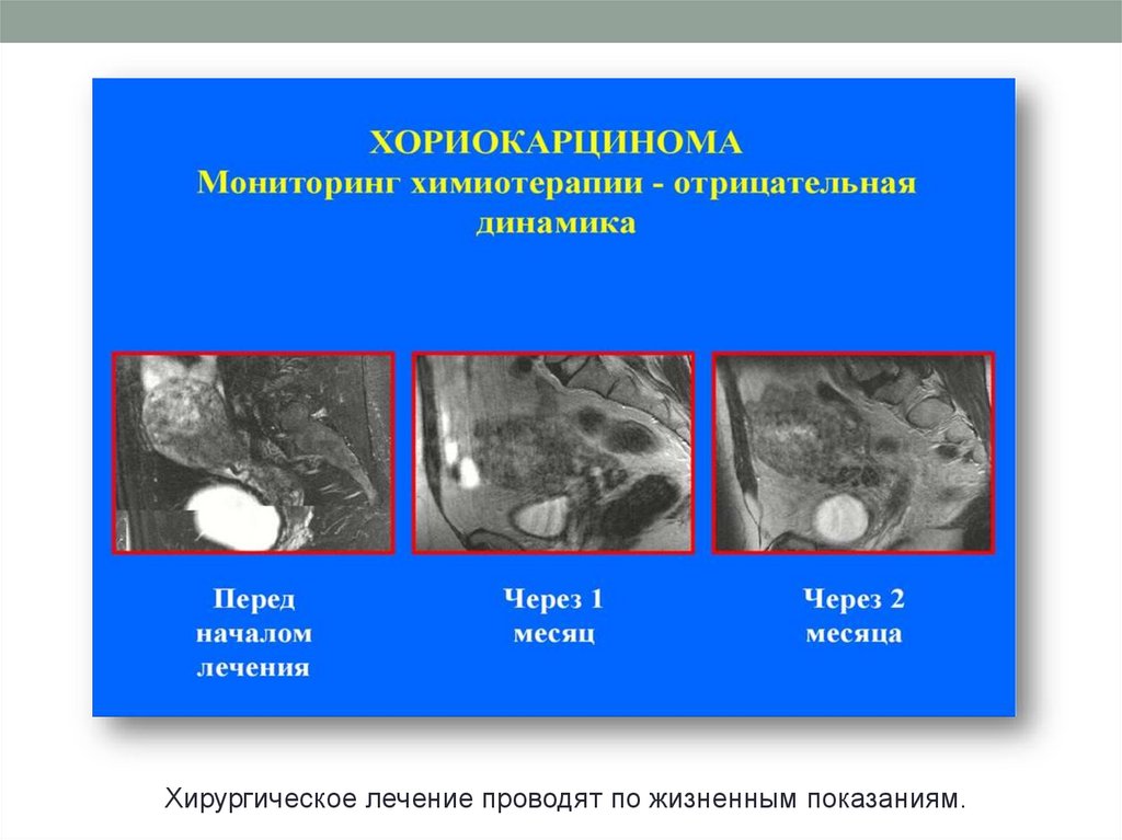 Хорионэпителиома - презентация онлайн