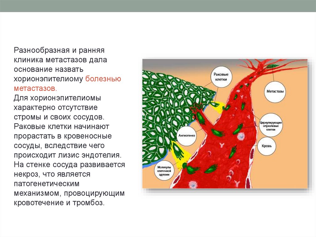 Хорионэпителиома - презентация онлайн