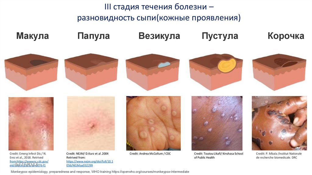 III стадия течения болезни – разновидность сыпи(кожные проявления)