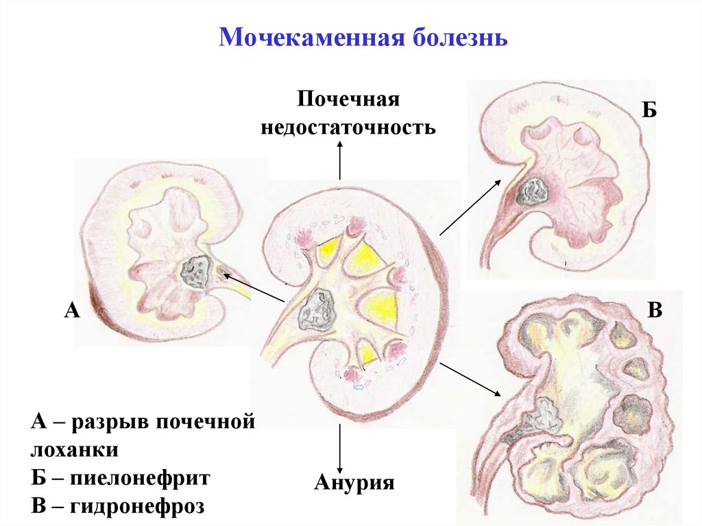 Заболевания почек при беременности. Заболевания мочевыделительной системы мочекаменная болезнь. Локализация камней при мочекаменной болезни. Мочекаменная болезнь (urolithiasis). Моче-КАМНЕННАЯ болезнь.