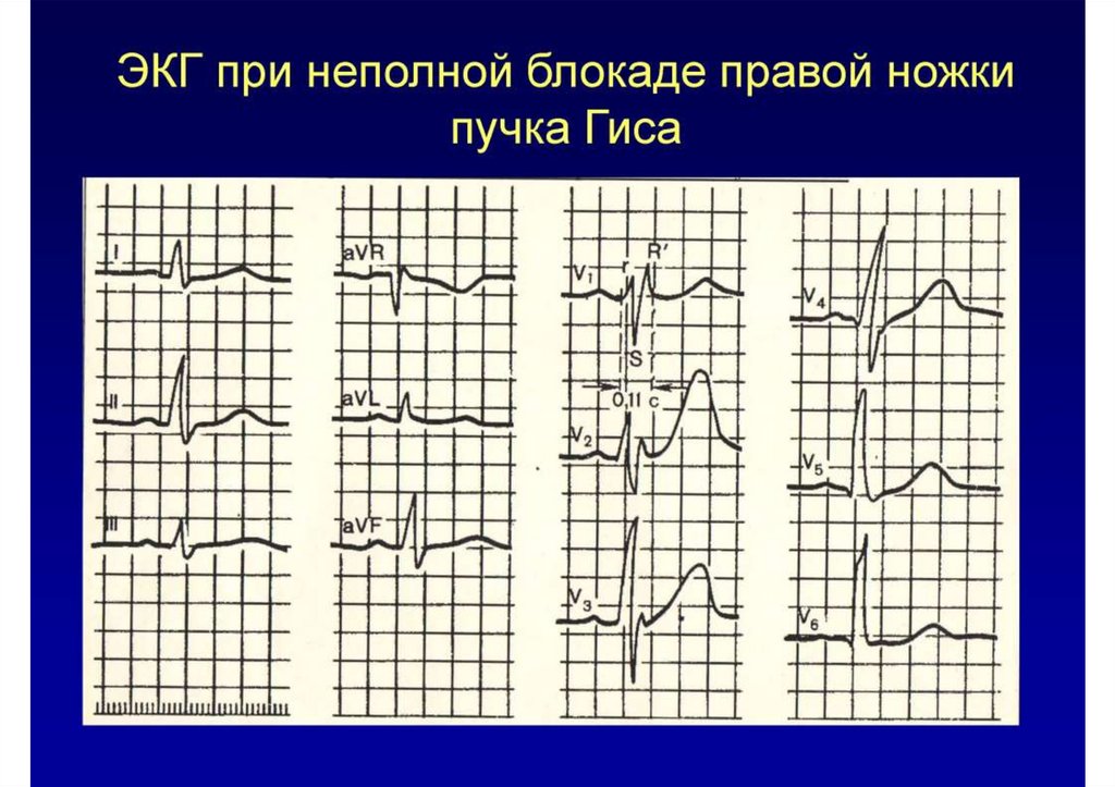 Ибс с нарушением ритма