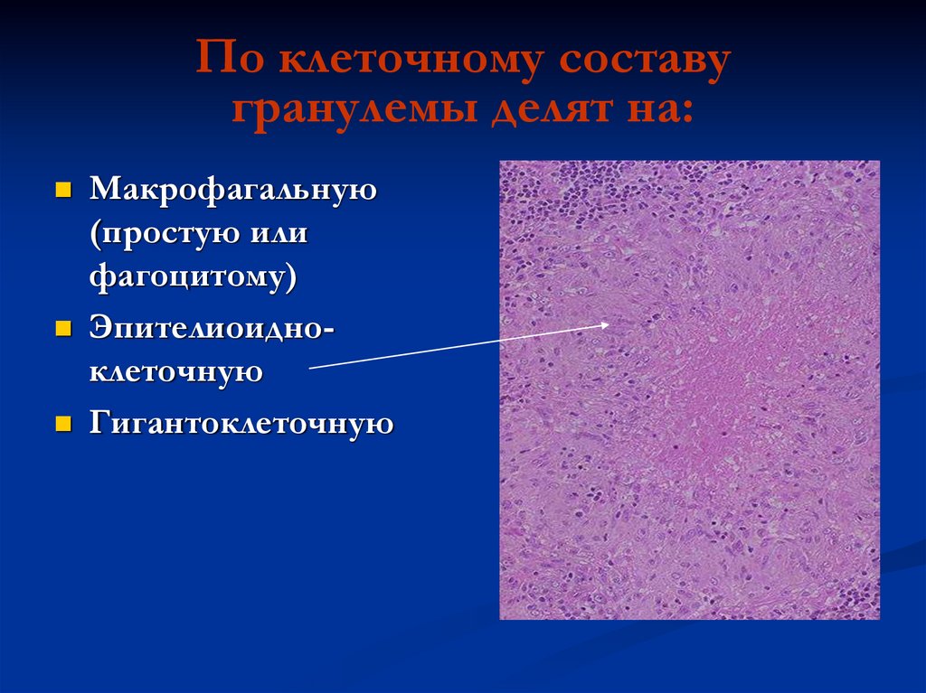 Клиническая картина периферической гигантоклеточной гранулемы характеризуется