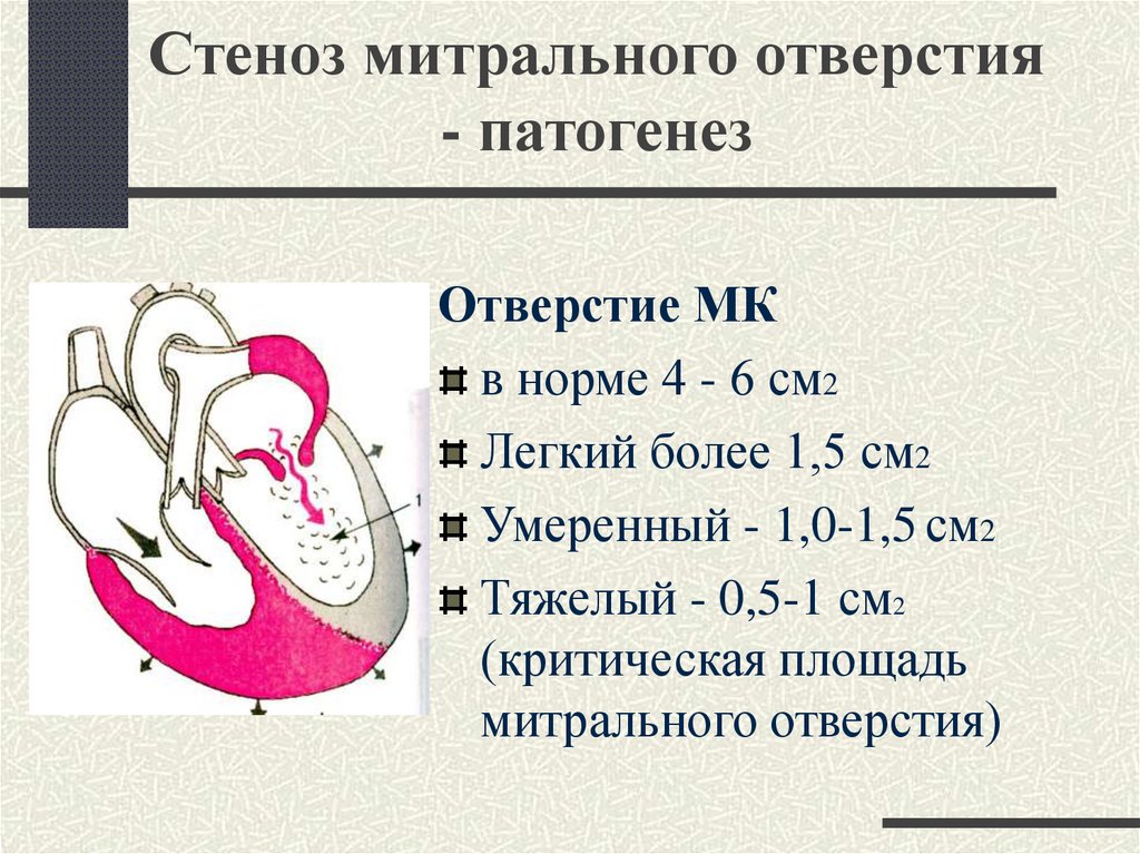 Митральное сердце