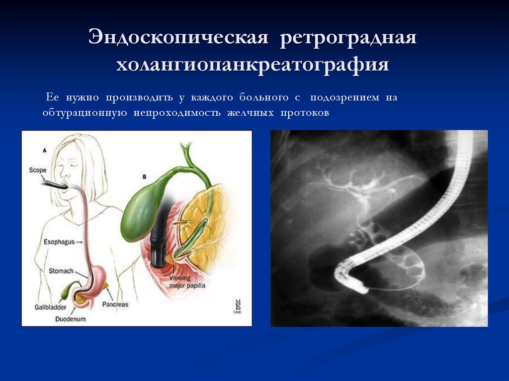 Холангиография