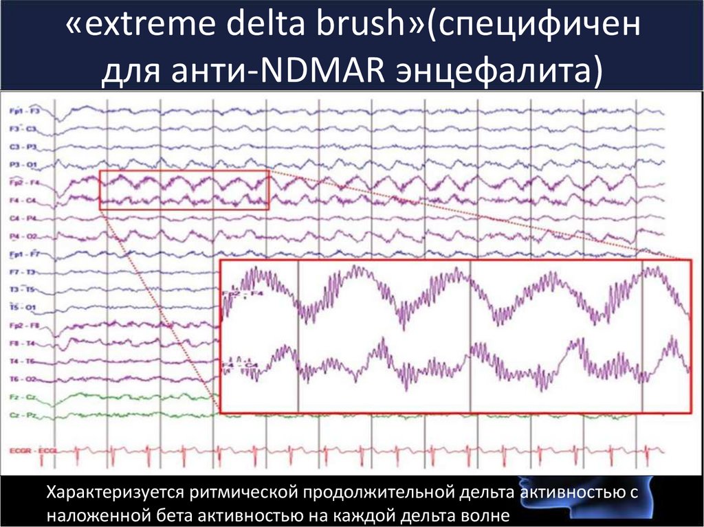 Высокая бета активность. Дельта активность. Медленоволновая Дельта активность. Медленоволновая Дельта активность сон. Как выглядит Дельта активность.