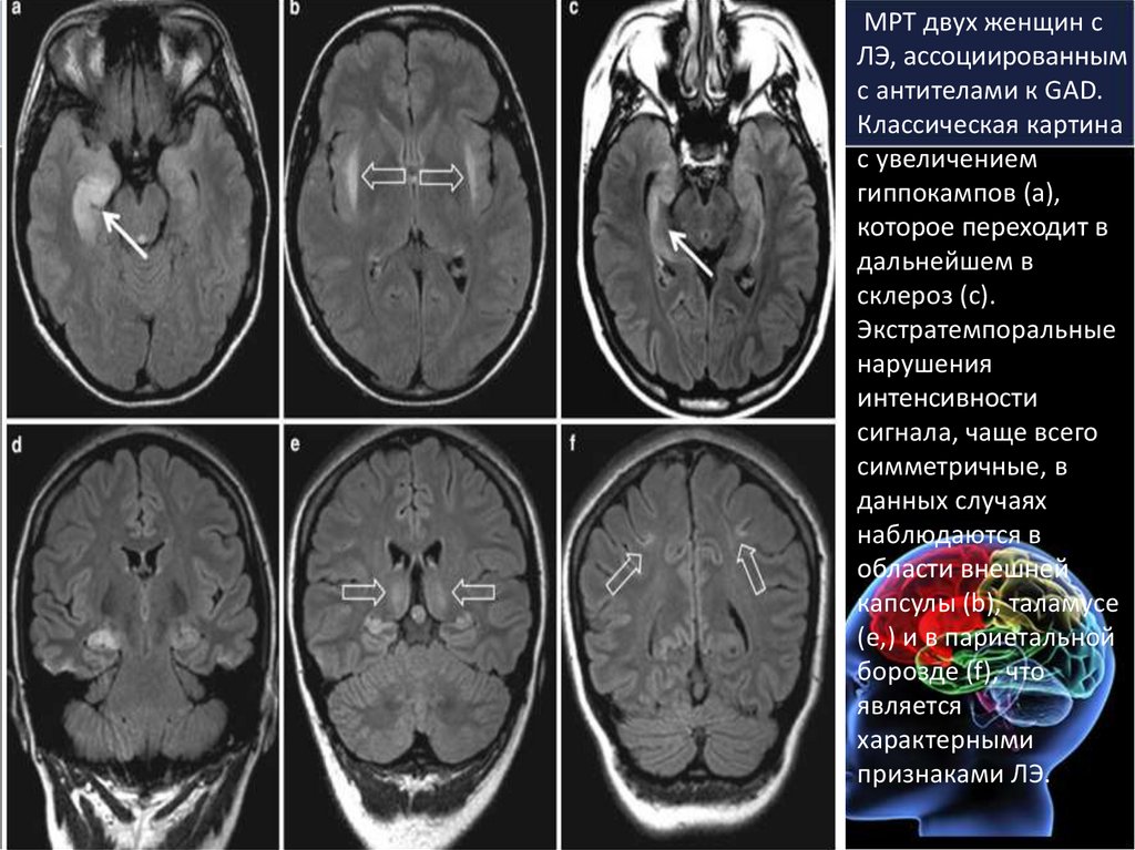 Энцефалит мрт картина
