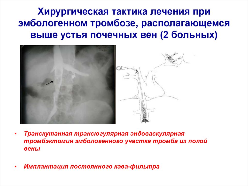 Хирургическое лечение тромбозов. Эмбологенным венозным тромбозом является. Эмбологенные заболевания. Хирургическая тромбэктомия при Тэла.