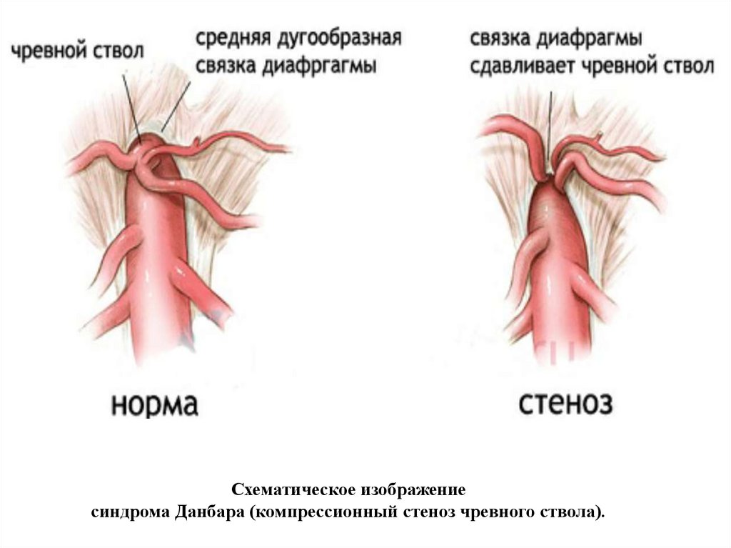 Синдром стеноза. Экстравазальное сдавление чревного ствола. Синдром компрессии чревного ствола брюшной аорты. Синдром сдавливания чревного ствола.