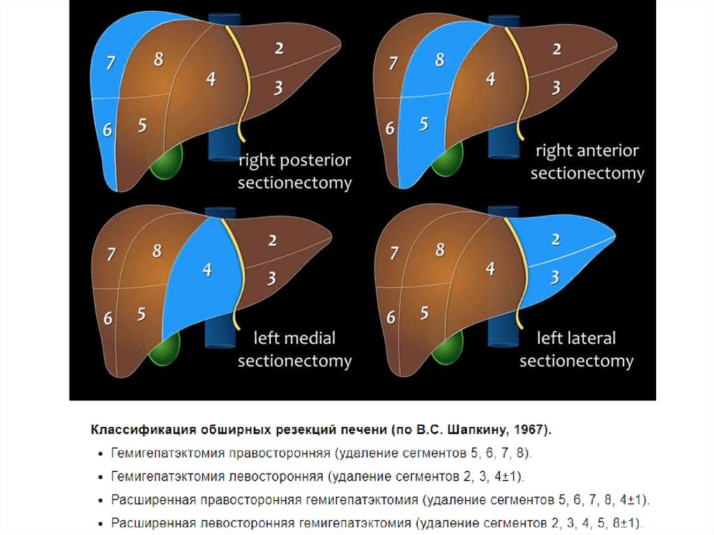 Тут картинка по видам резекции печени (две классификации разных стран)