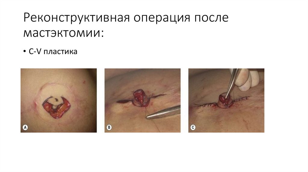 Реконструктивная операция после мастэктомии: