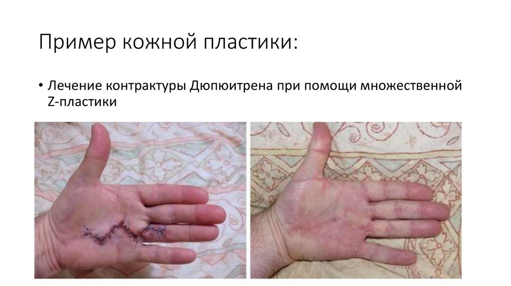 Пример кожной пластики:
