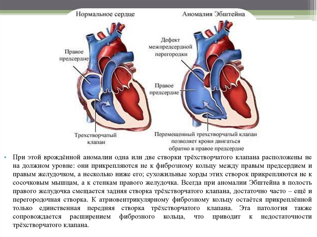 Предсердия и желудочки сердца. Створки трехстворчатого клапана анатомия. Аномалия Эбштейна схема. Трехстворчатый клапан сердца правое предсердие. Двухстворчатый клапан расположен между.