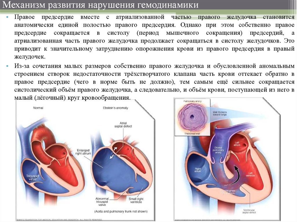 Аномалия эбштейна фото