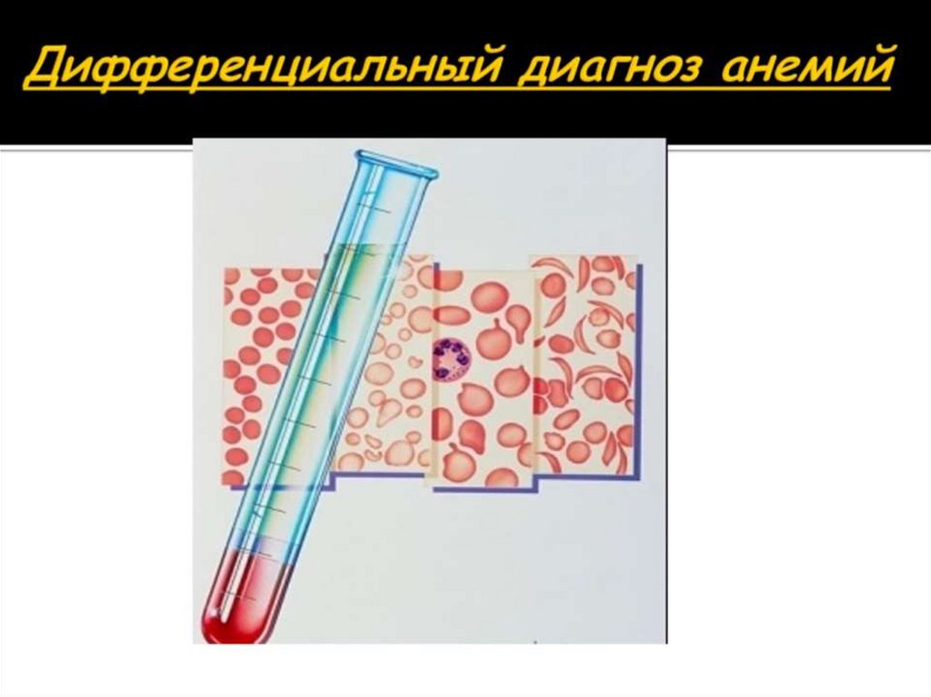 Дифференциальный диагноз анемий