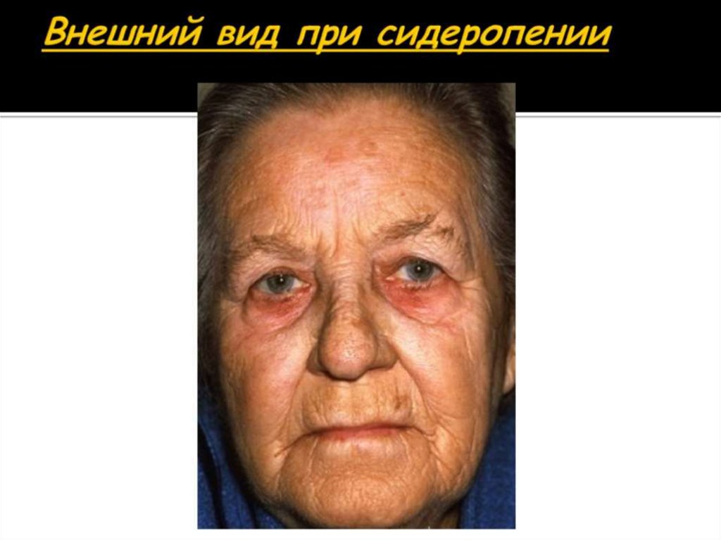 Внешний вид при сидеропении