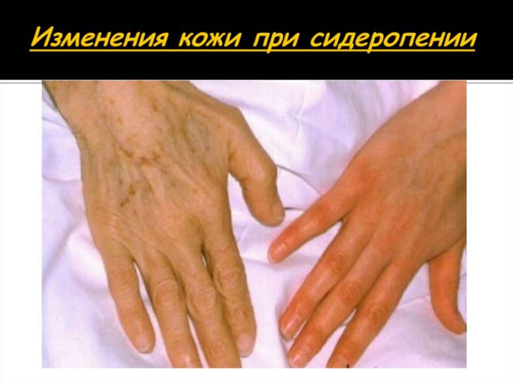 Изменения кожи при сидеропении
