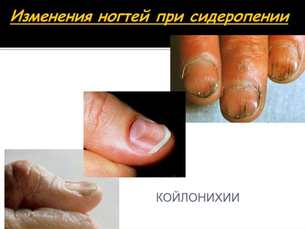 Изменения ногтей при сидеропении