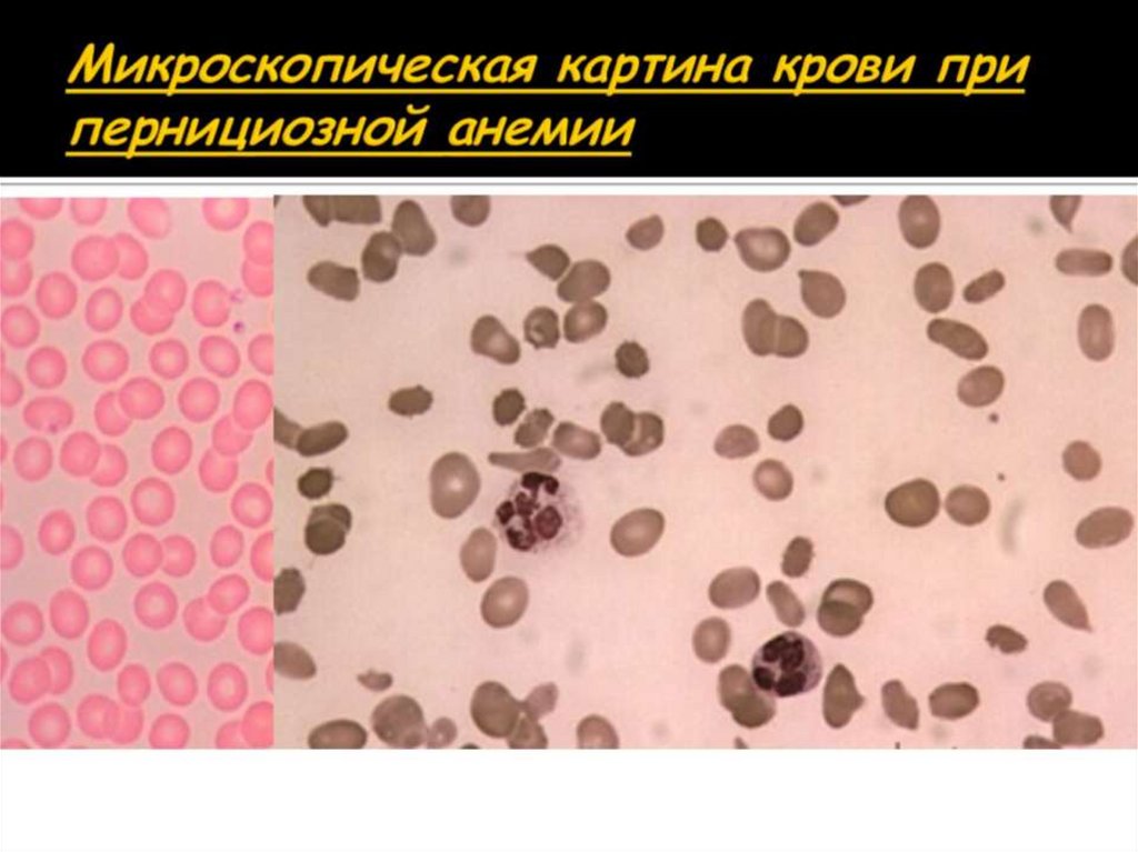 Микроскопическая картина крови при пернициозной анемии