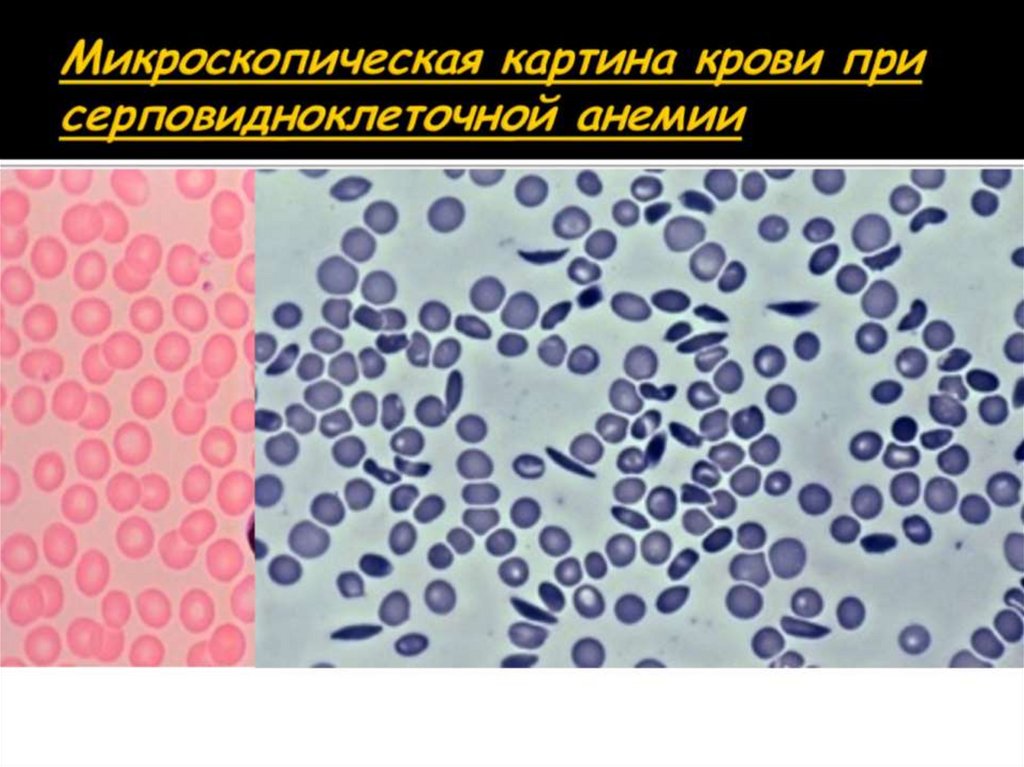 Микроскопическая картина крови при серповидноклеточной анемии