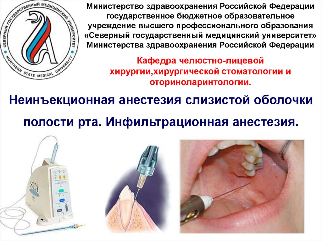 Неинъекционная анестезия слизистой оболочки полости рта. Инфильтрационная анестезия.