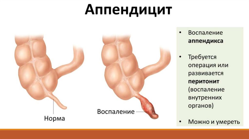 Где Аппендицит Фото