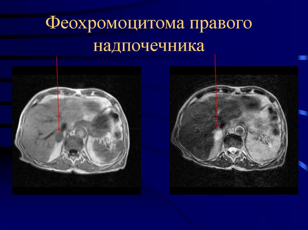 Киста надпочечника. Опухоль надпочечника на кт. Феохромоцитома надпочечника кт контраст. Объемные образования надпочечников на кт.