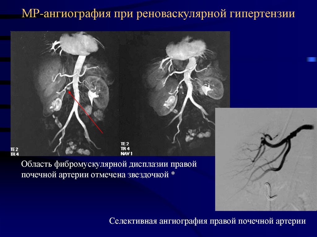 Тромбоз почечной артерии. Селективная ангиография сосудов. Фибромышечная дисплазия почечных артерий. Магнитно резонансная ангиография почек. Кт ангиография почечных артерий.