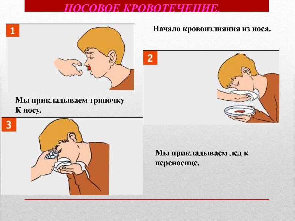 Необходимые действия при носовом кровотечении. Оказание первой помощи при носовом кровотечении. Оказание помощи при кровотечении из носа.
