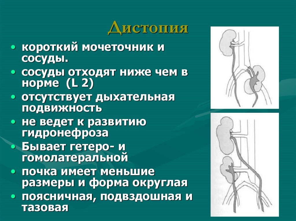 Дистопия левой почки