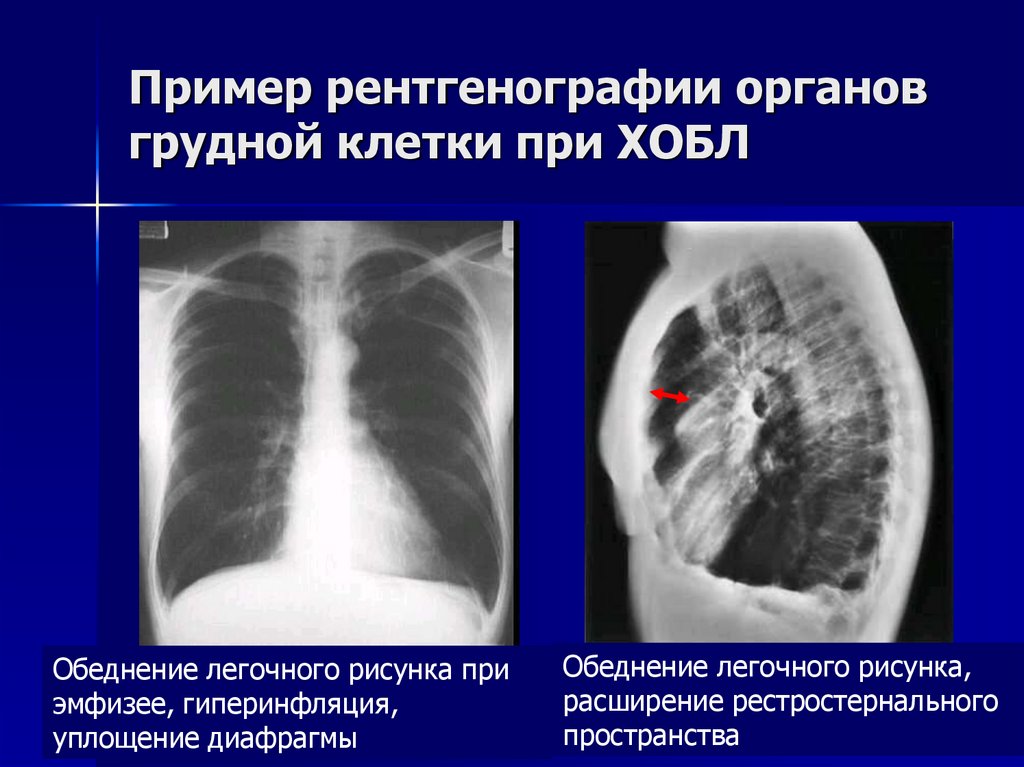 Пример рентгенографии органов грудной клетки при ХОБЛ