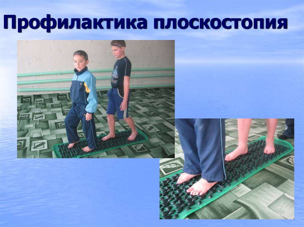 Профилактика плоскостопия