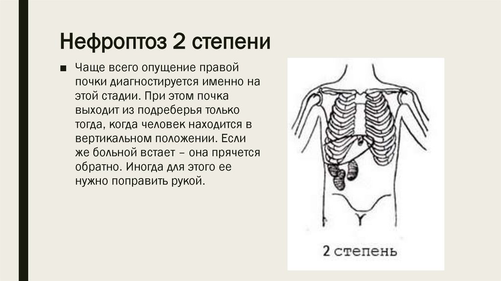 Стадии нефроптоза