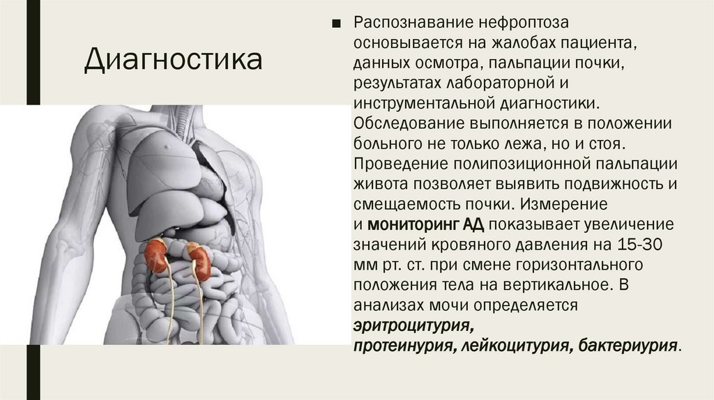 Нефроптоз почки симптомы лечение. Нефроптоз влияние на кишечник. Бандаж при нефроптозе почечный как должен выглядеть.