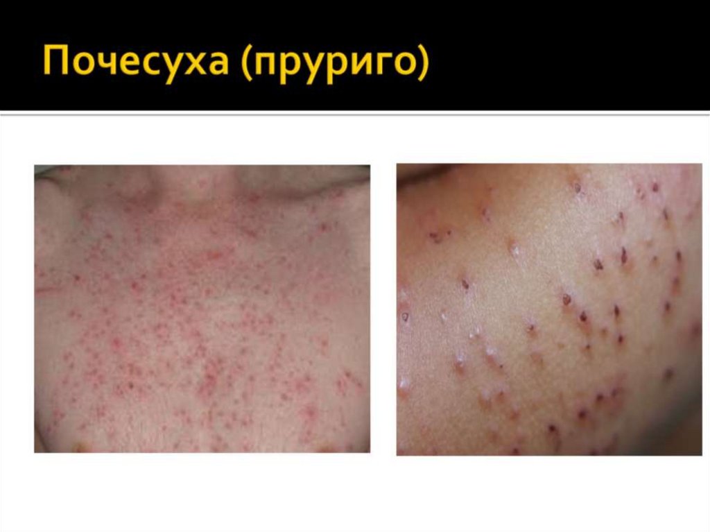 Почесуха (пруриго)