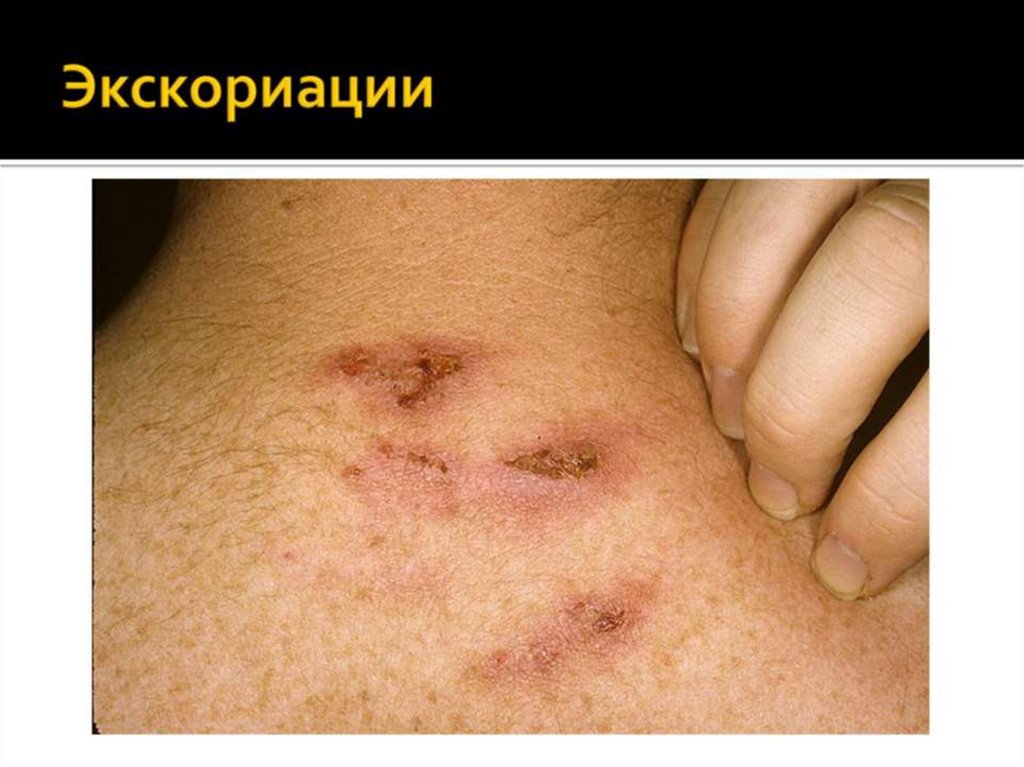 Экскориации