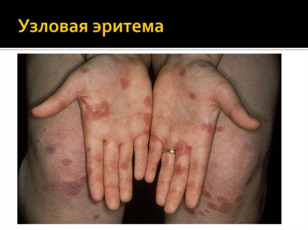 Узловая эритема