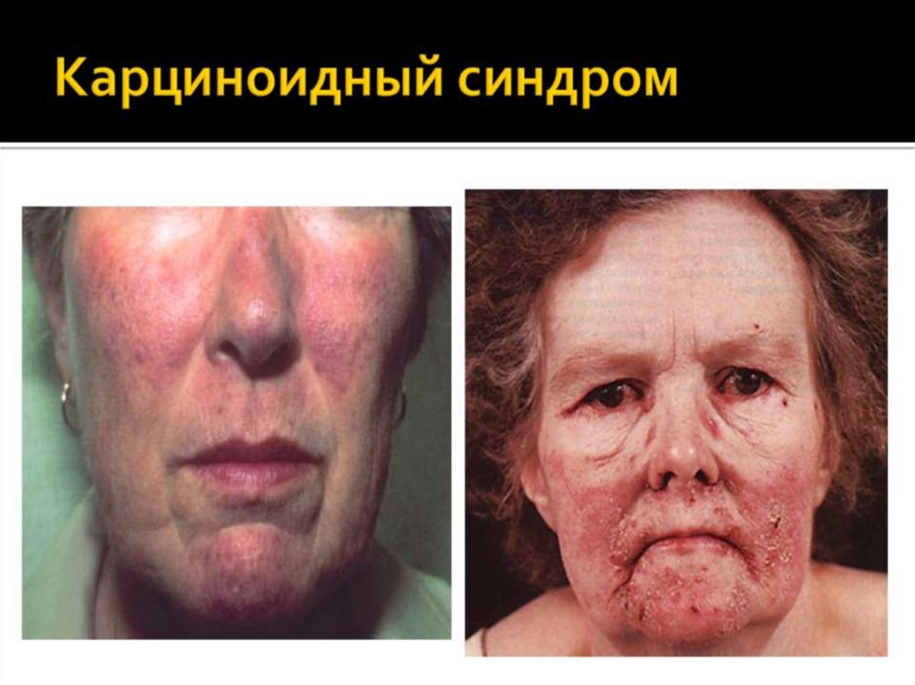 Карциноидный синдром