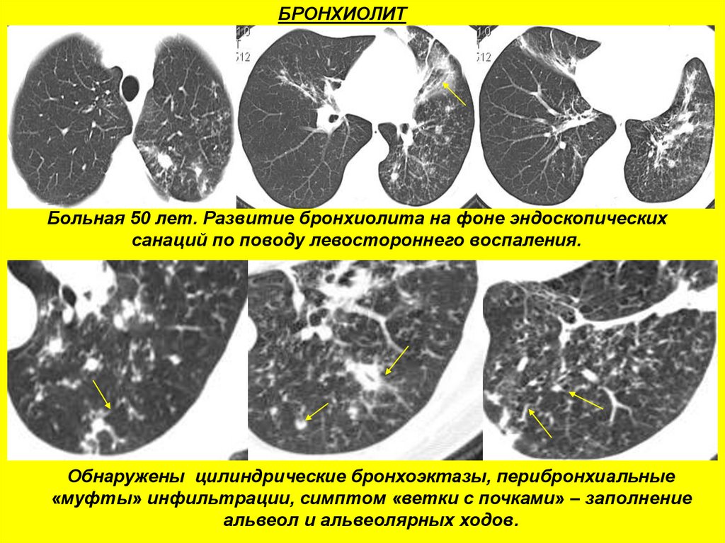 Бронхиолит это. Неспецифическая пневмония. Перибронхиальная инфильтрация. Фолликулярный бронхиолит кт.
