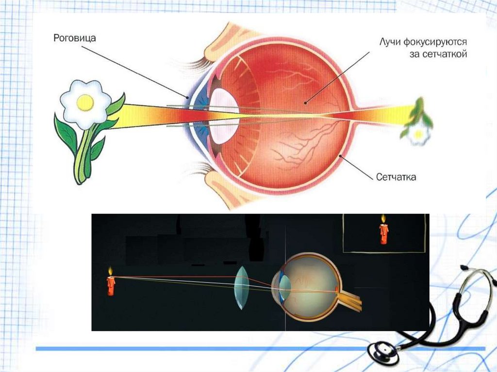 Предмет фокусируется перед сетчаткой. Фокусировка глаза. Фокусировка глаза человека. Лучи фокусируются перед сетчаткой. Как фокусируется глаз.