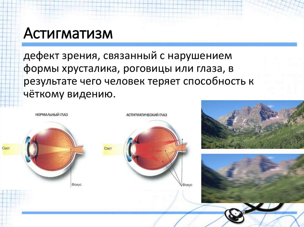 Астигматизм