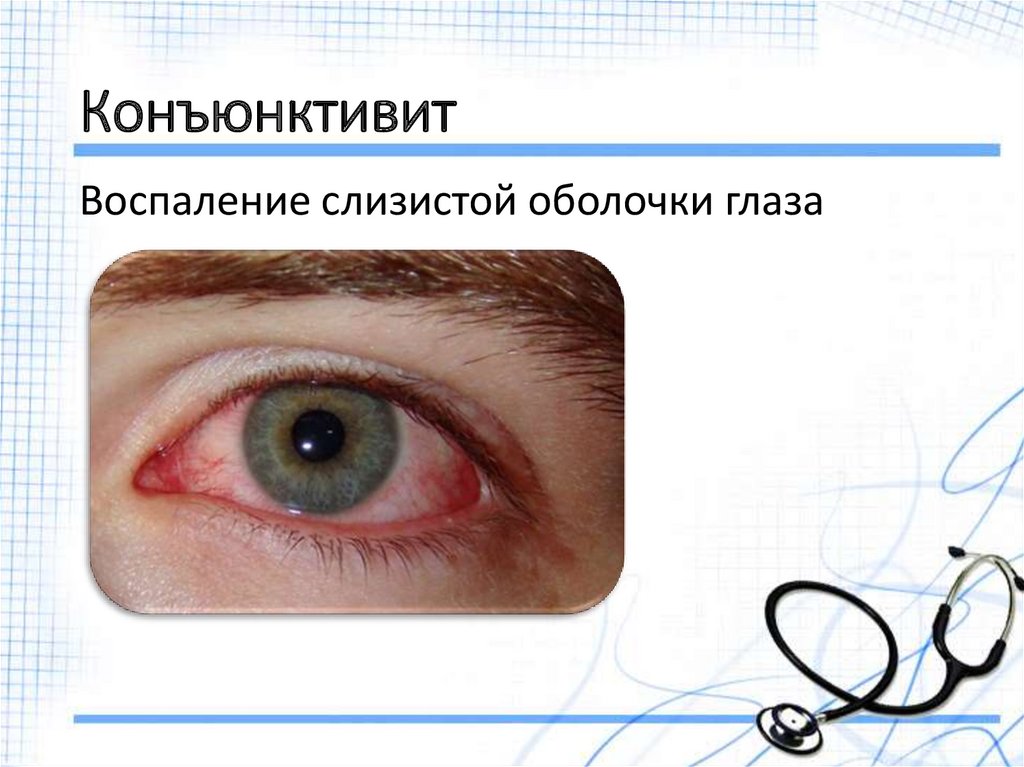 Конъюнктивит