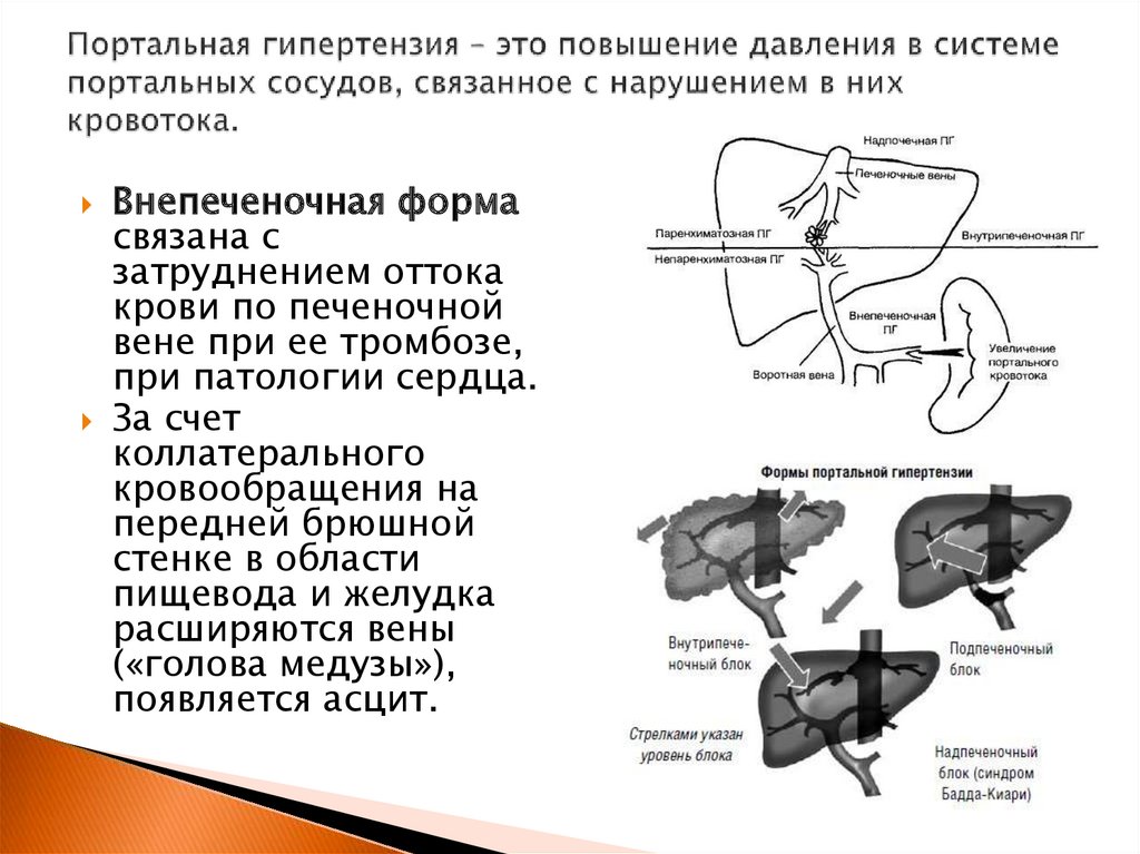 Портальная гипертензия развивается при