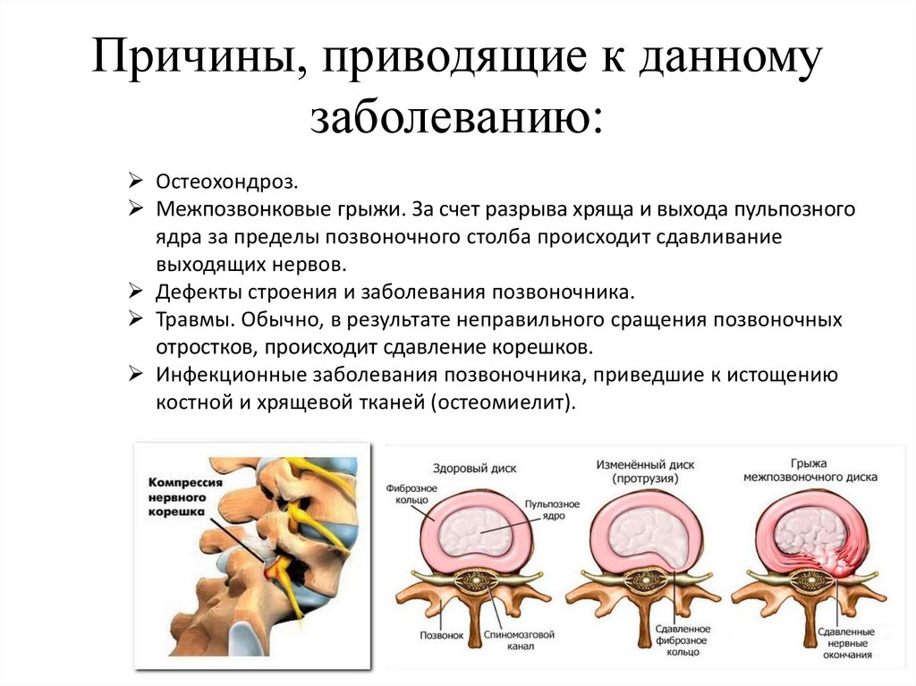 Синдромы поясничного отдела позвоночника