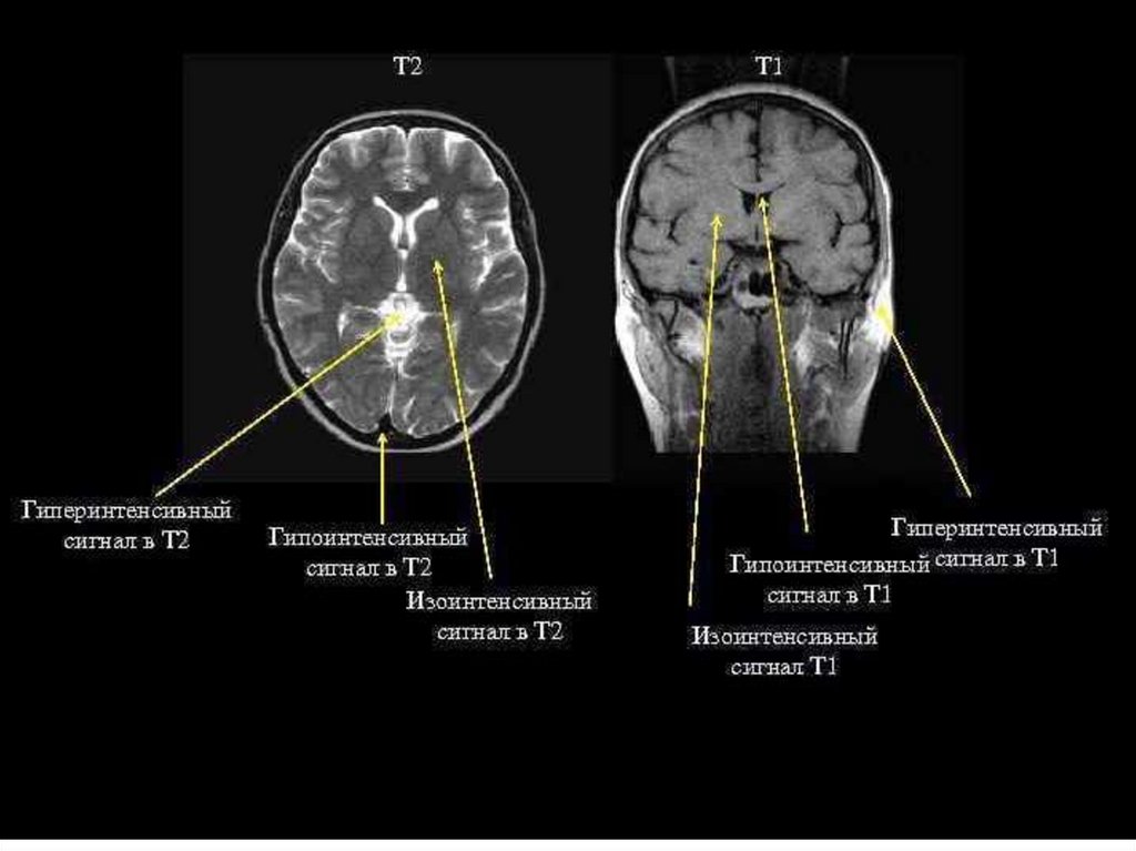 Т1 и т2 изображения мрт
