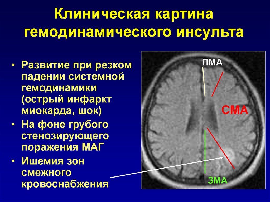 Инсульт в бассейне мозговой артерии. Инсульт в ПМА. ОНМК В ПМА. Инсульт задней мозговой артерии. Ишемический инсульт в бассейне СМА.