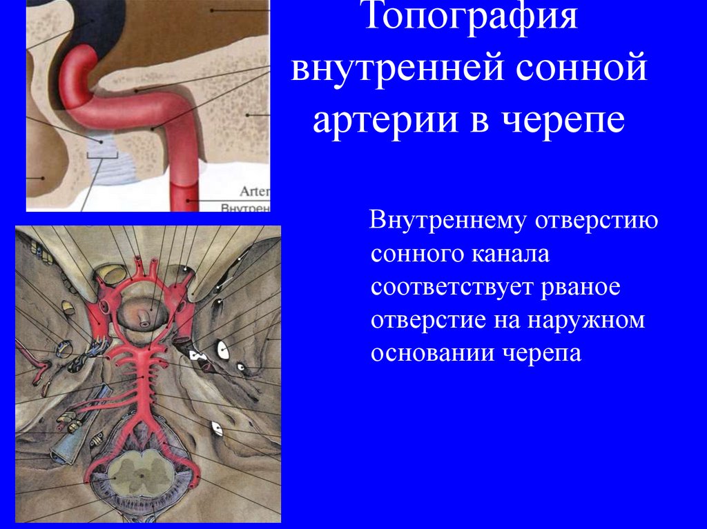 Интракраниальный отдел внутренней сонной артерии